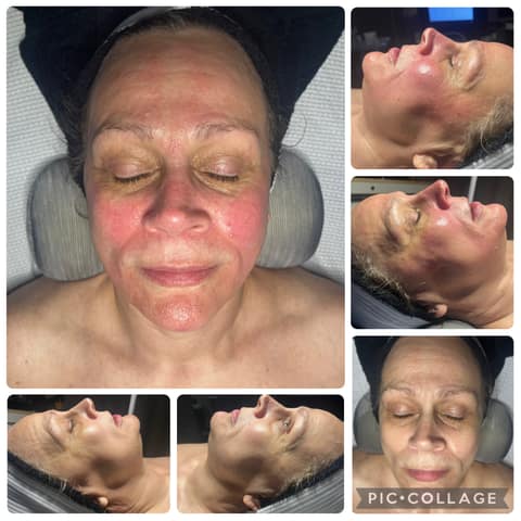 Photo collage of a client during and immediately after a facial treatment session at the O'Fallon studio; temporary redness right after treatment is normal