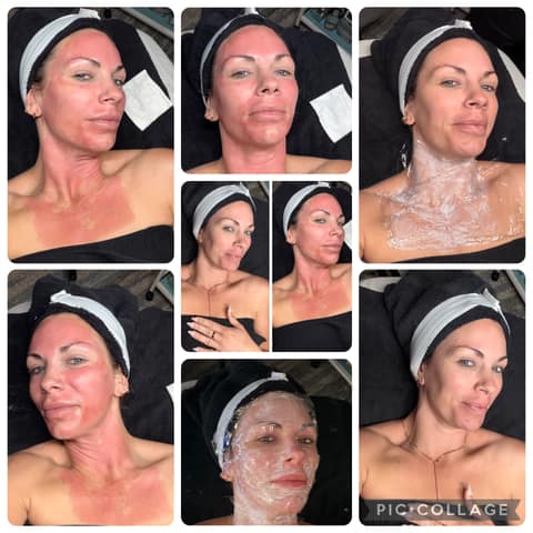 Photo collage of a client during a Rejuva Pen microneedling session at the O'Fallon studio; temporary redness immediately after treatment is normal